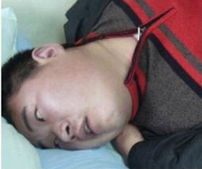 癫痫并发症一般有哪些